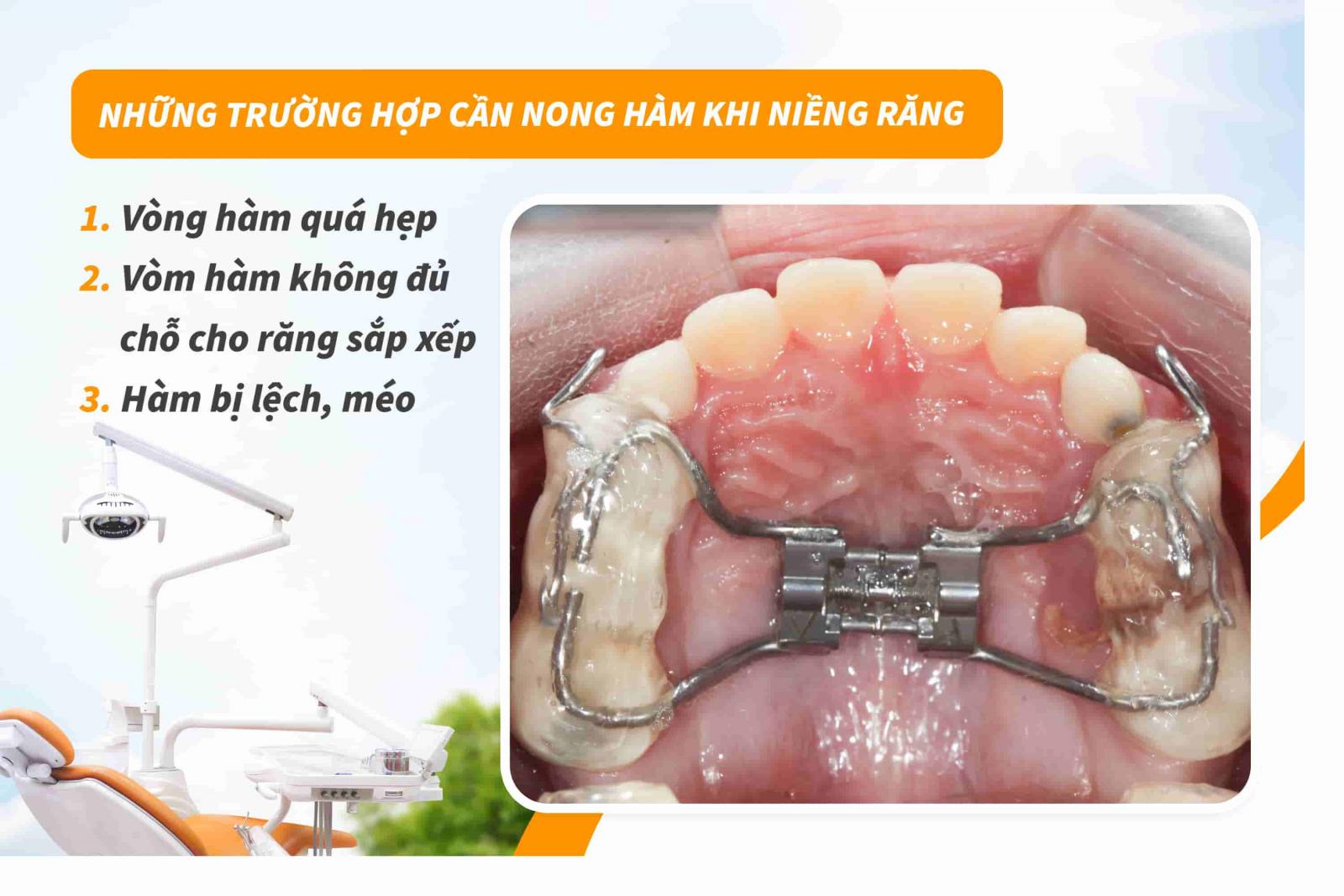 Những trường hợp cần nong hàm khi niềng răng