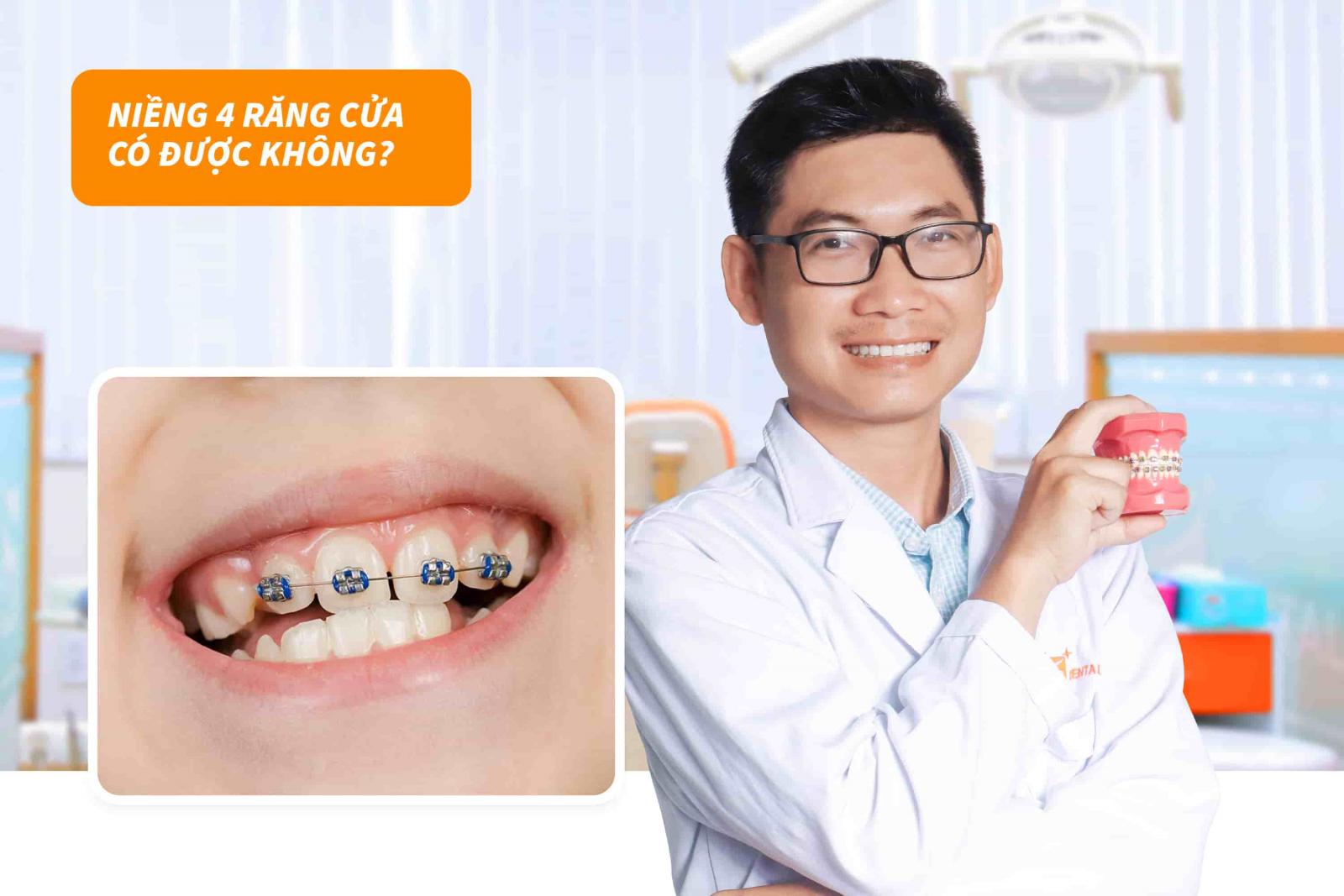 Niềng 4 răng cửa có được không?