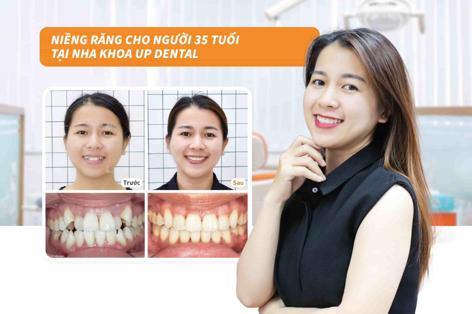 Niềng răng cho người 35 tuổi tại nha khoa Up Dental