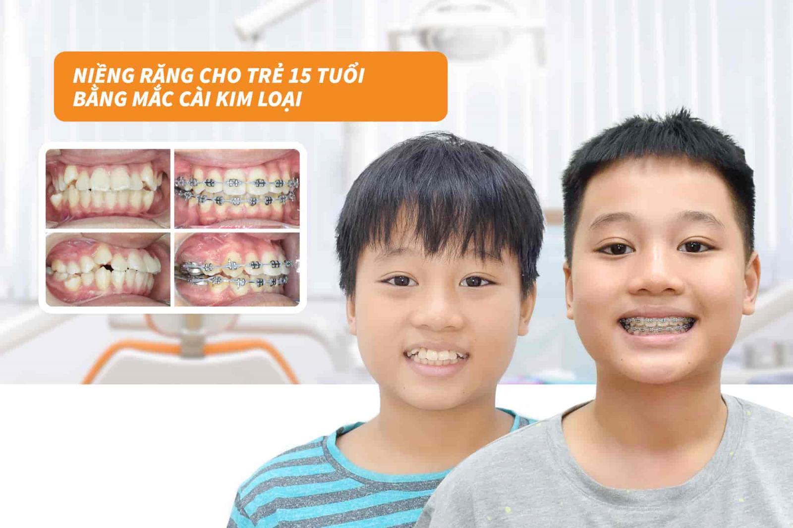 Niềng răng cho trẻ 15 tuổi bằng mắc cài kim loại