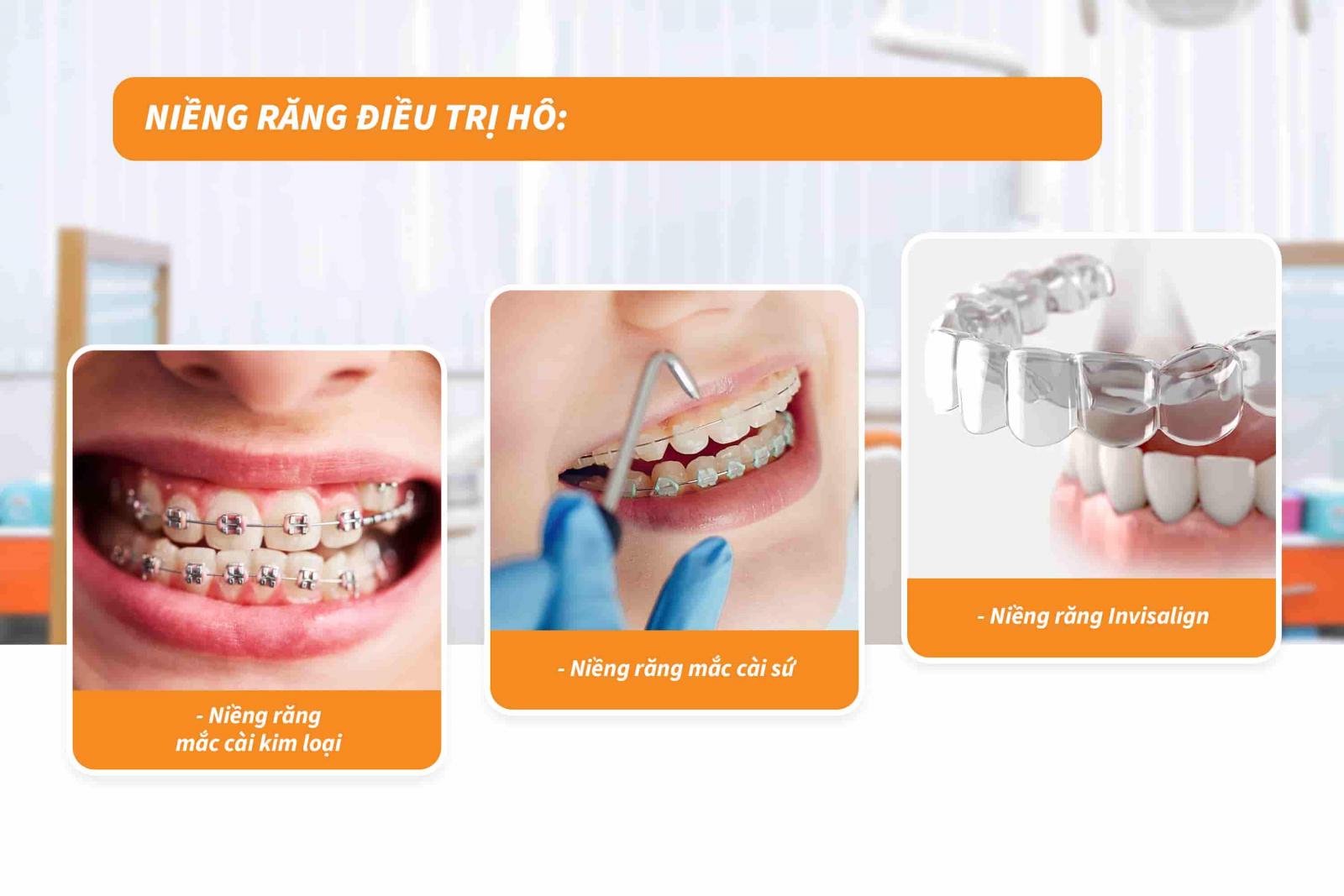 Cách điều trị hô răng và hô hàm