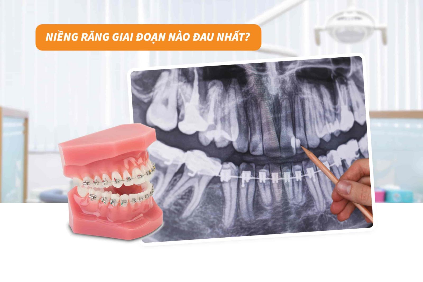 Niềng răng giai đoạn nào là đau nhất?