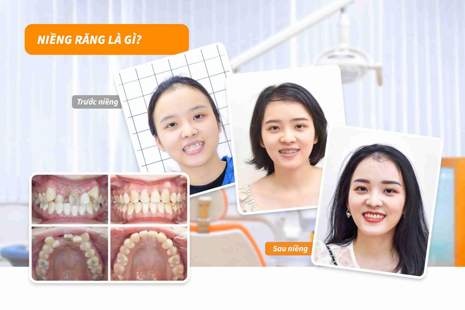 Niềng răng là gì?
