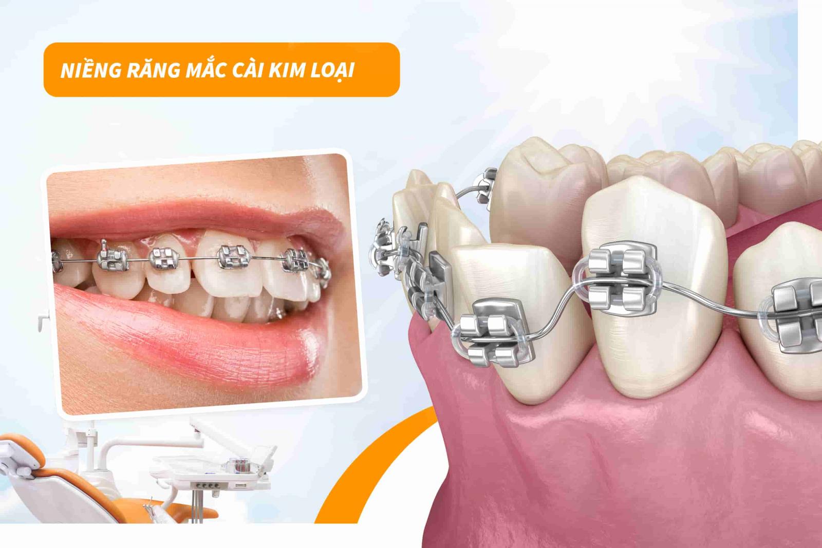 Niềng răng mắc cài kim loại