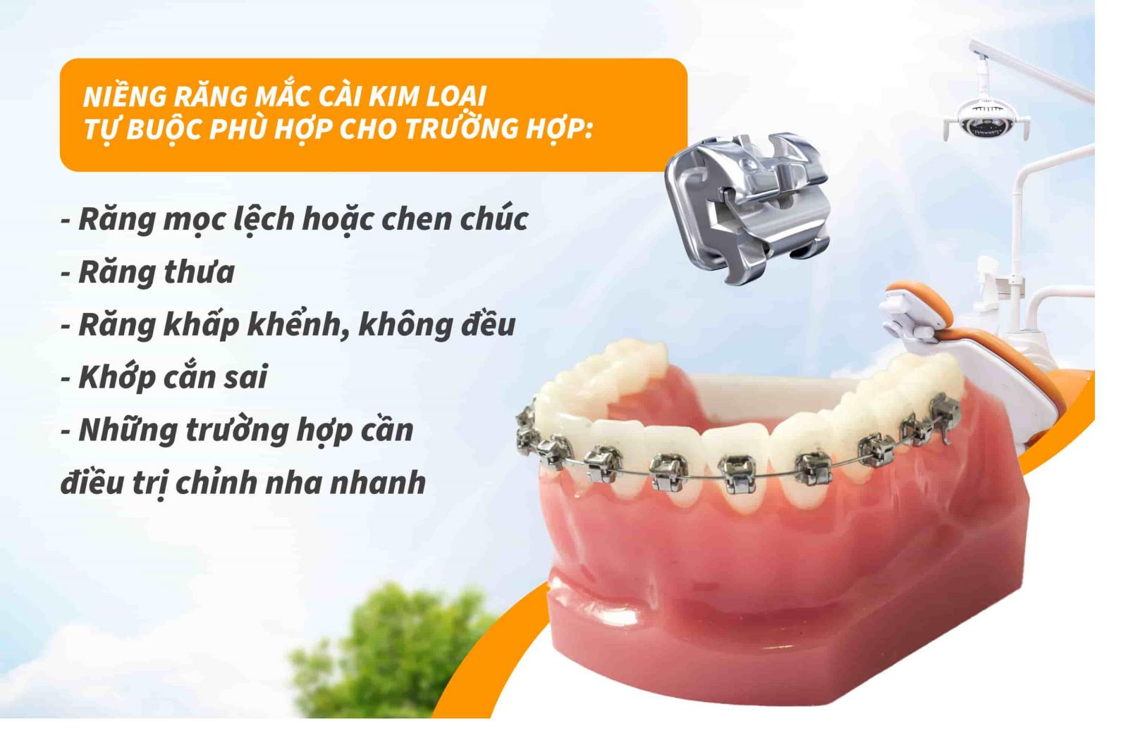 Niềng răng mắc cài kim loại tự buộc phù hợp cho trường hợp nào?