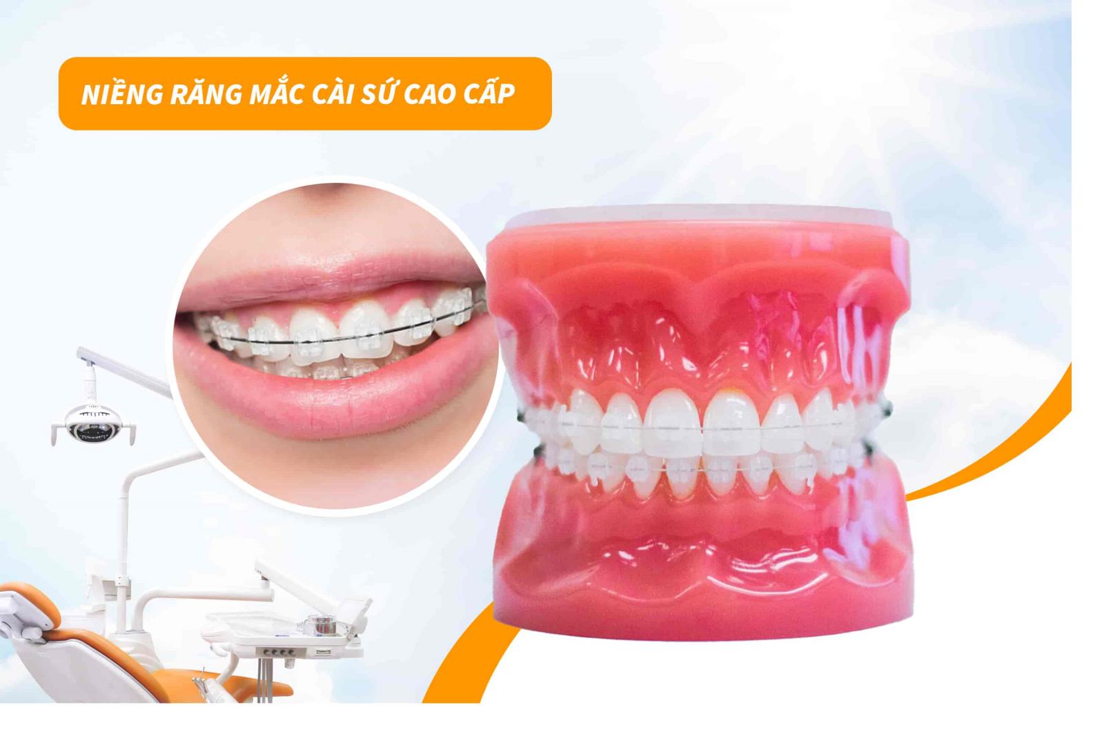 Niềng răng mắc cài sứ cao cấp