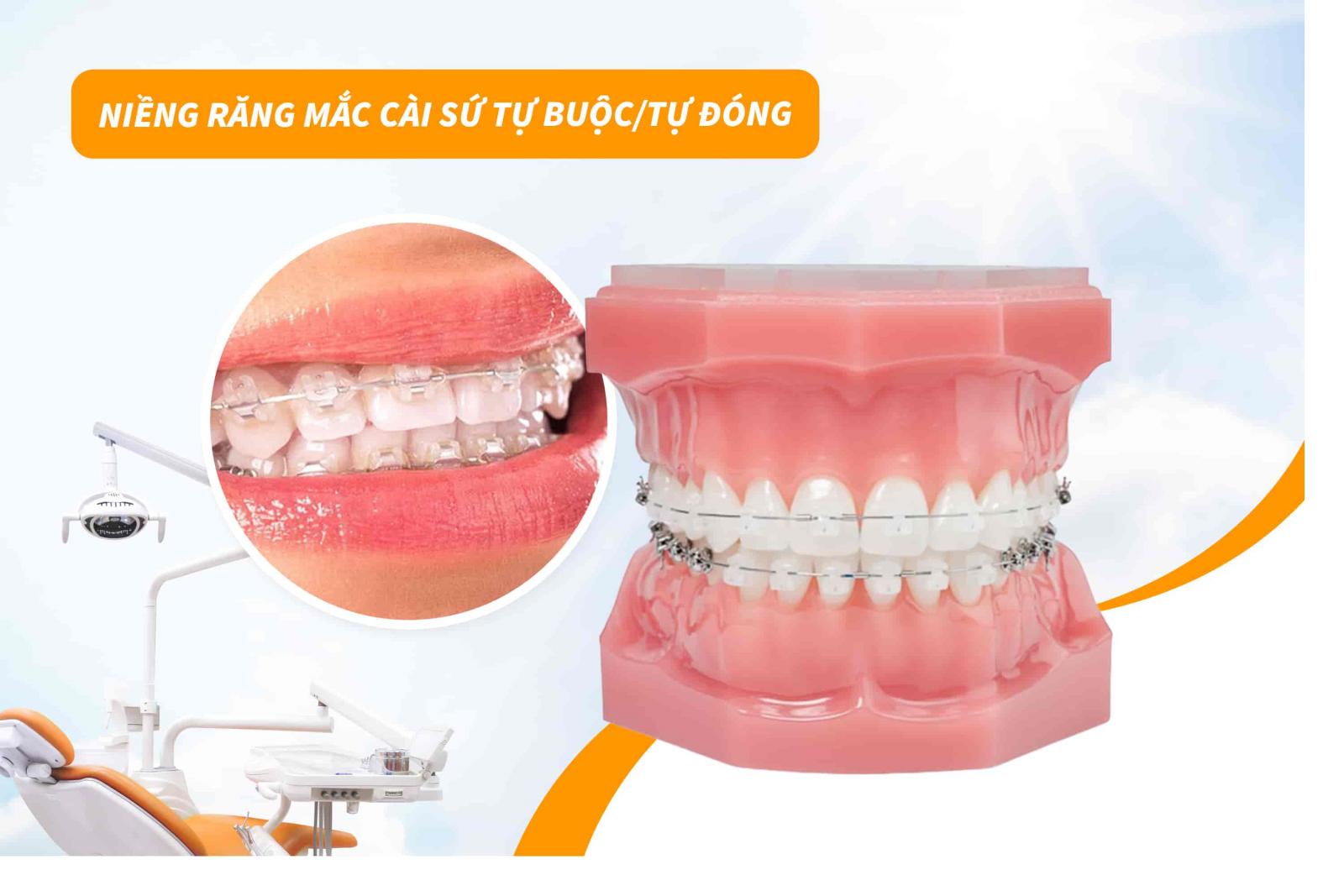 Giá niềng răng mắc cài sứ tự buộc/tự đóng