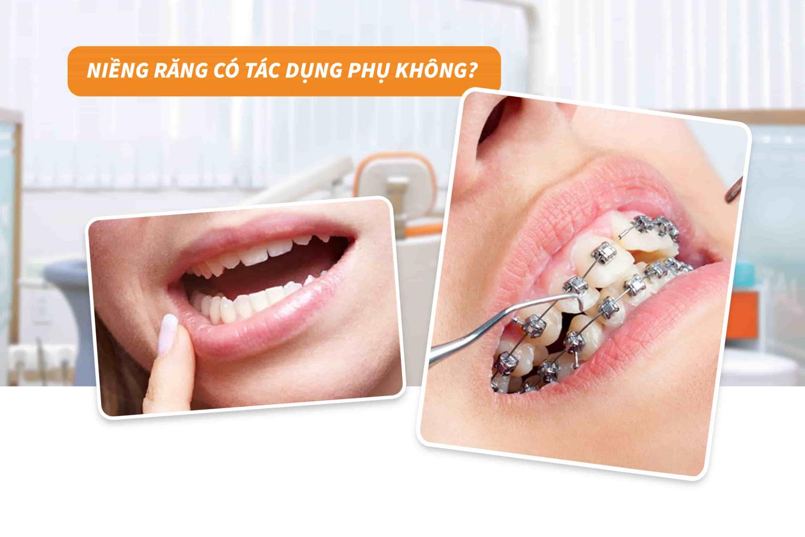 Niềng răng có tác dụng phụ không?