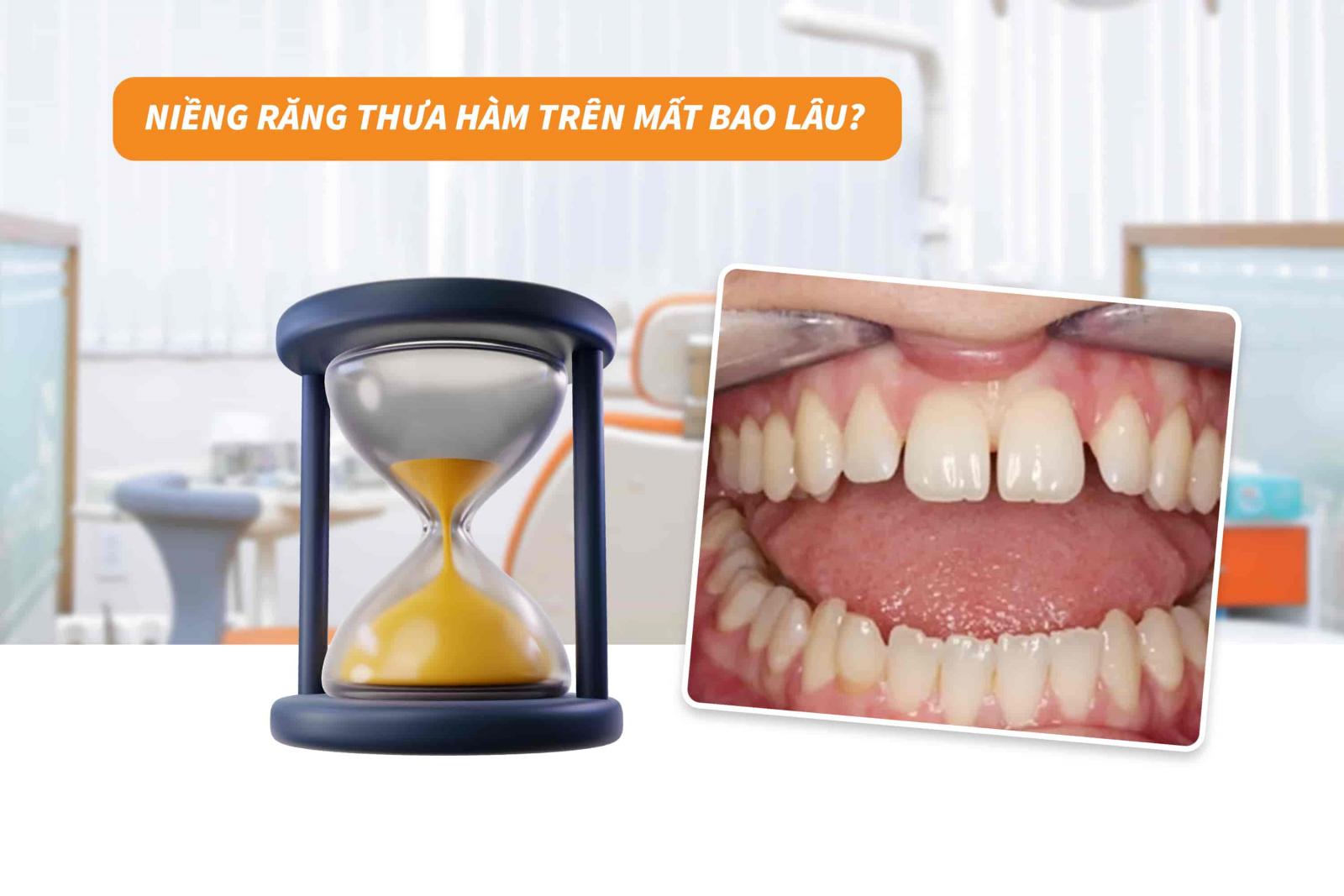 Niềng răng thưa một hàm mất bao lâu?