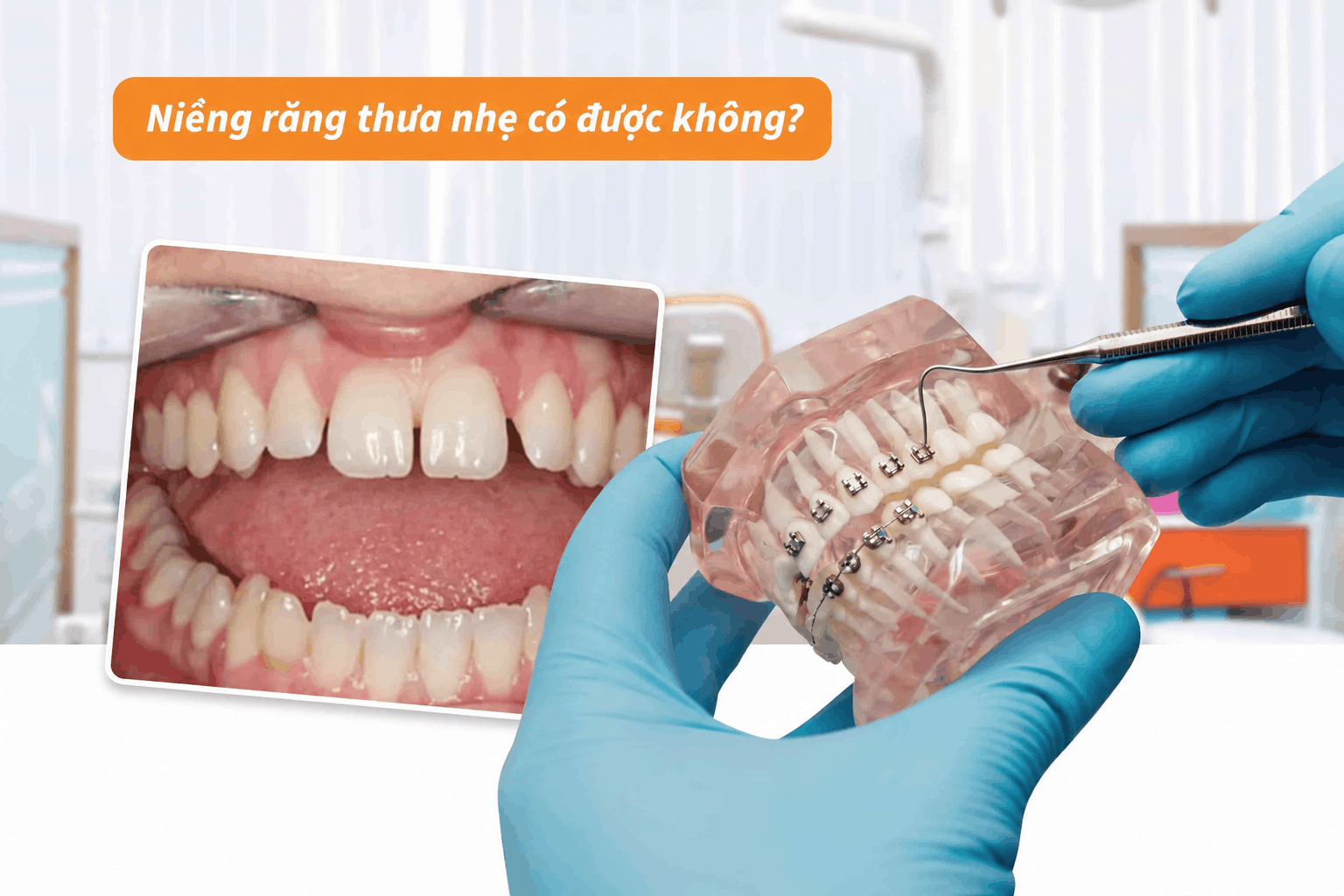 Niềng răng thưa nhẹ có được không?