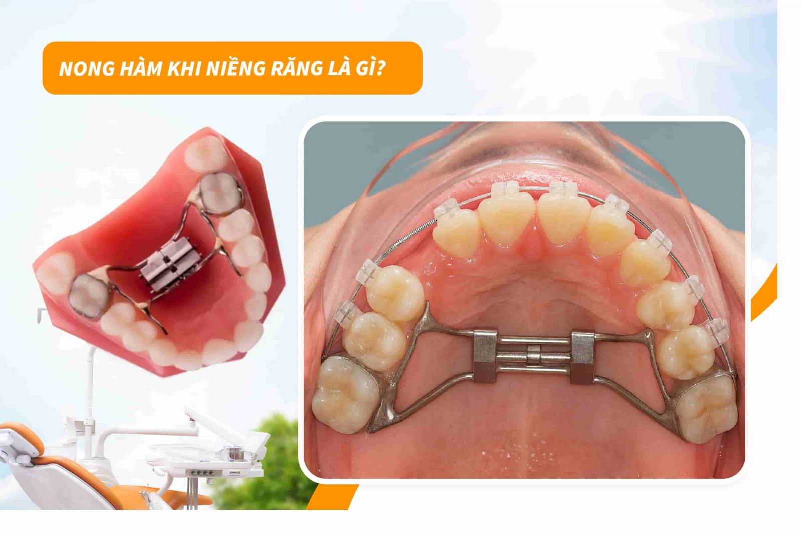 Nong hàm khi niềng răng là gì?