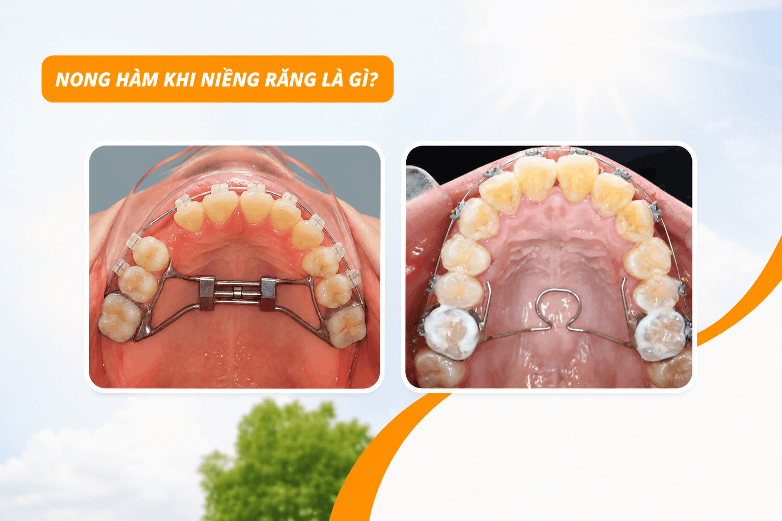 Nong hàm khi niềng răng là gì?