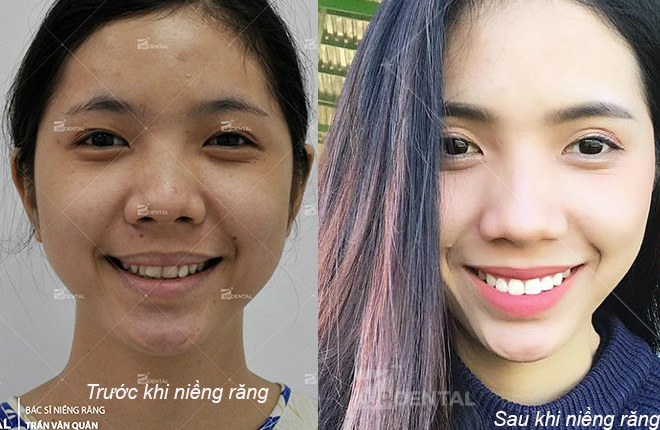 hinh anh truoc va sau nieng rang