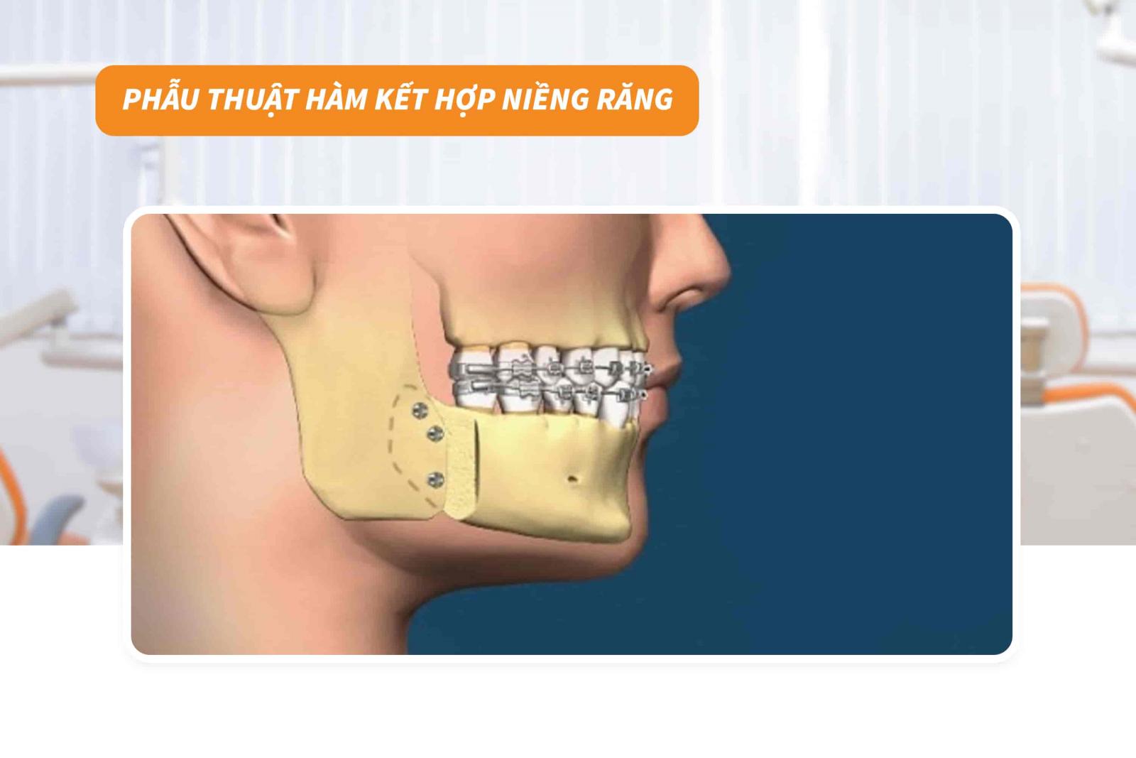 Phẫu thuật kết hợp niềng răng