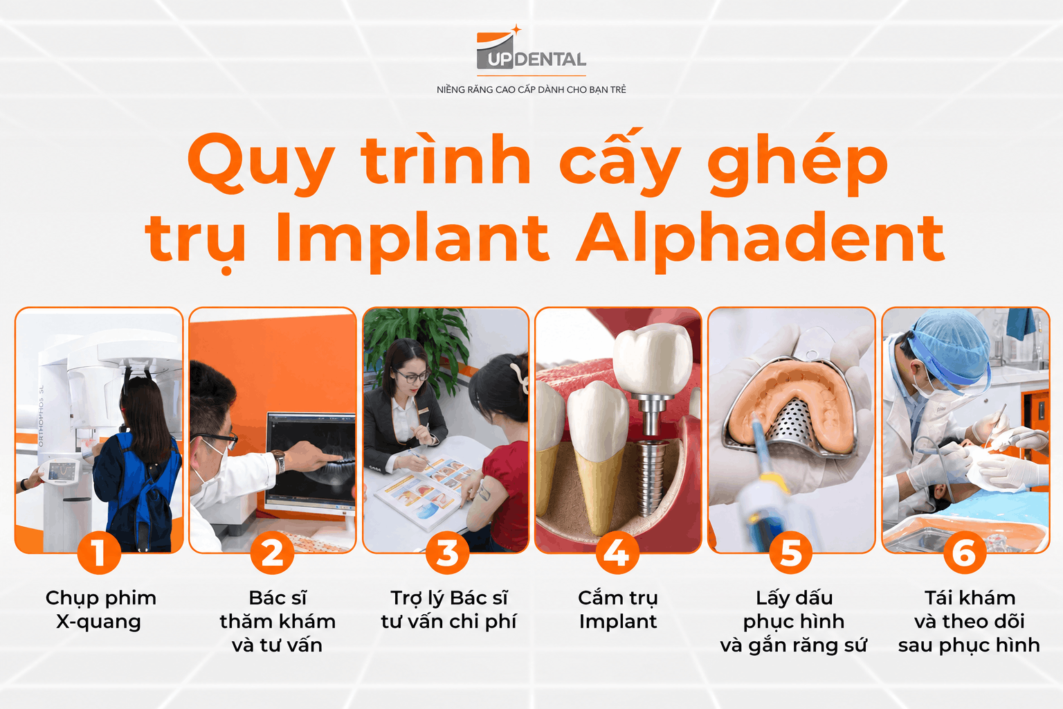 Quy trình cấy ghép trụ Implant Alphadent