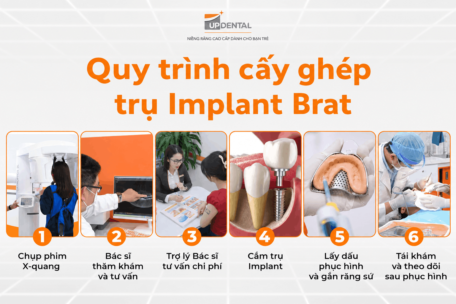 Quy trình cấy ghép trụ Implant Brat