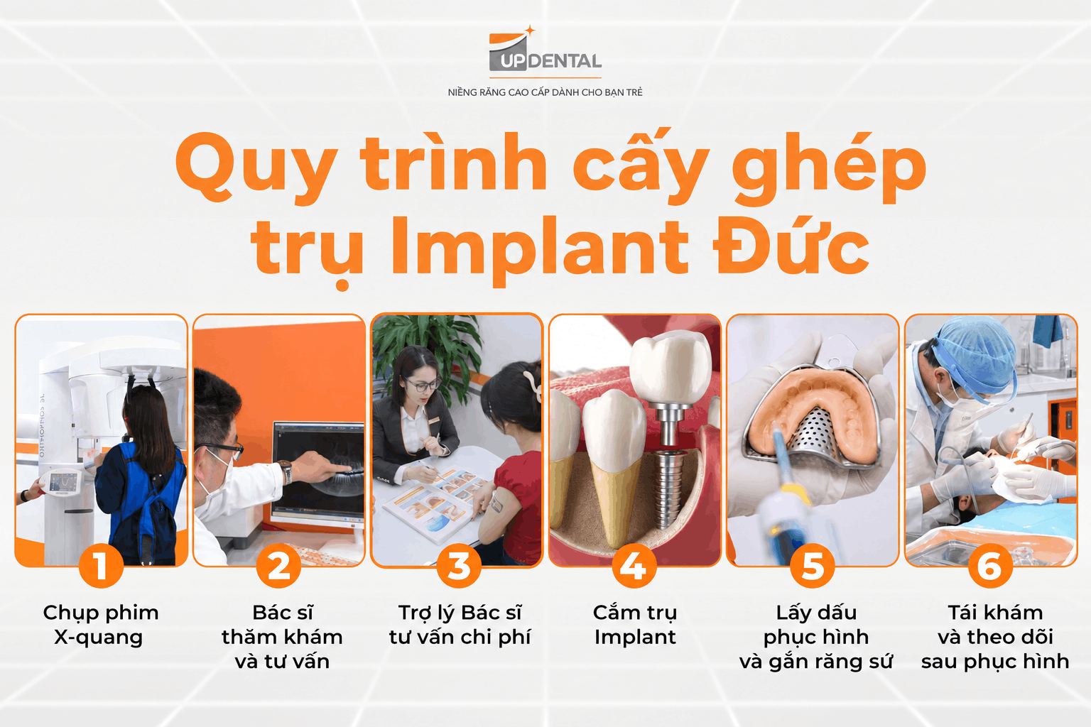 Quy trình cấy ghép trụ Implant Đức