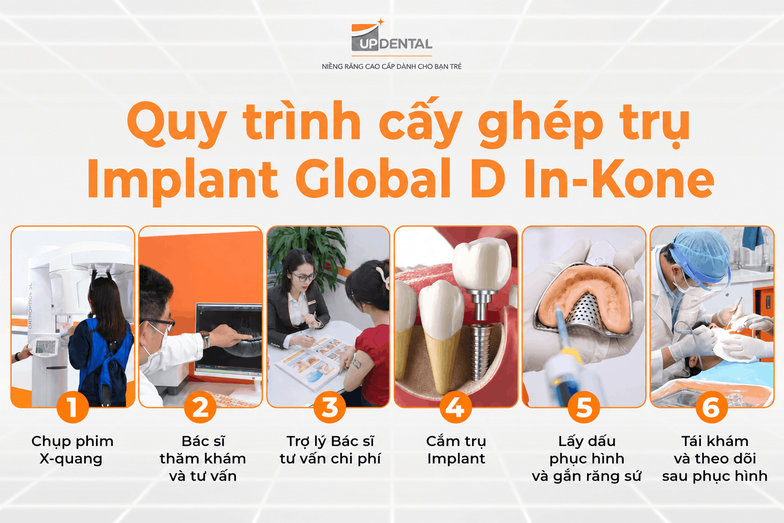 Quy trình cấy ghép trụ Implant Global D In-Kone