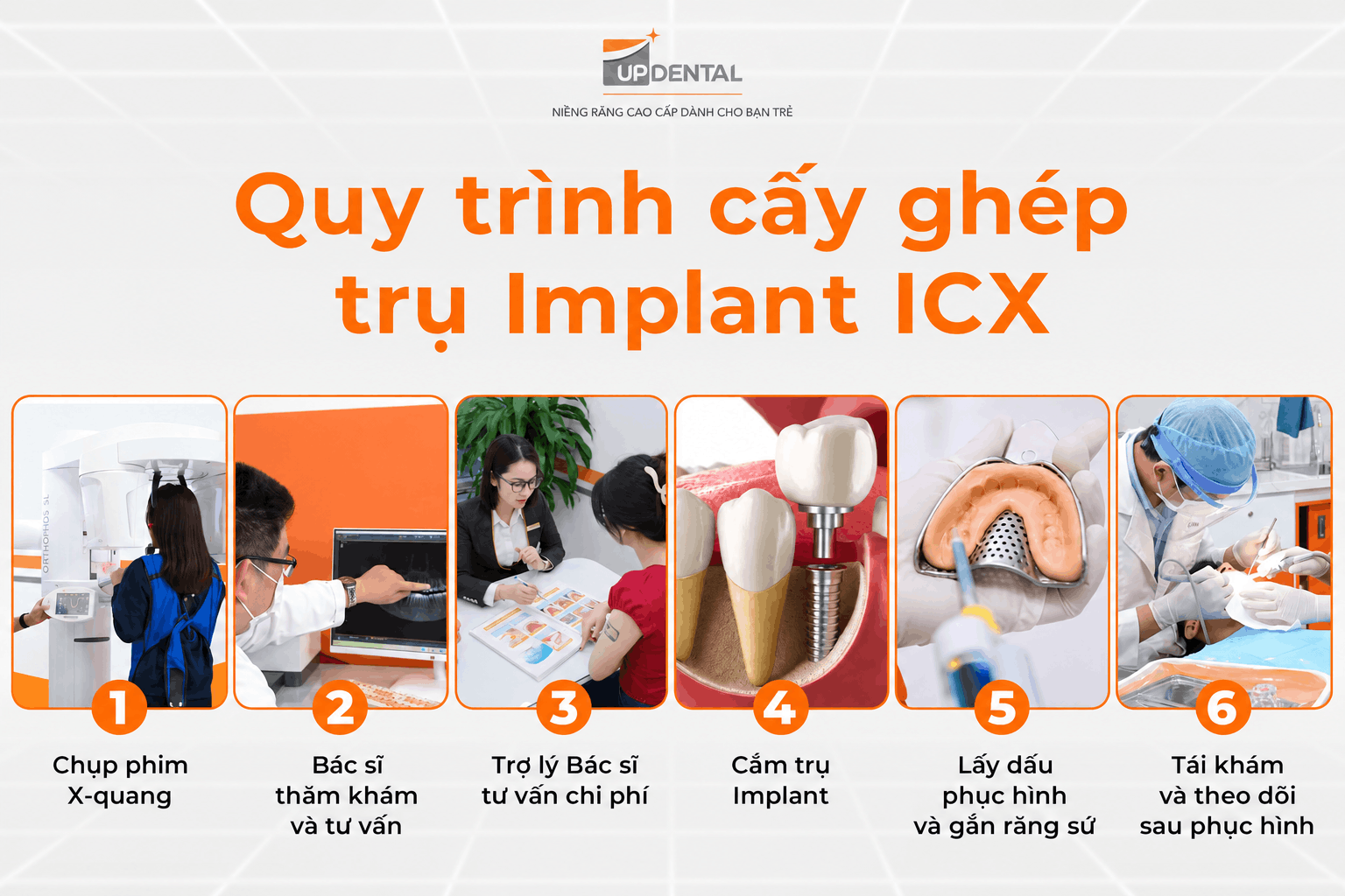 Quy trình cấy ghép trụ Implant ICX