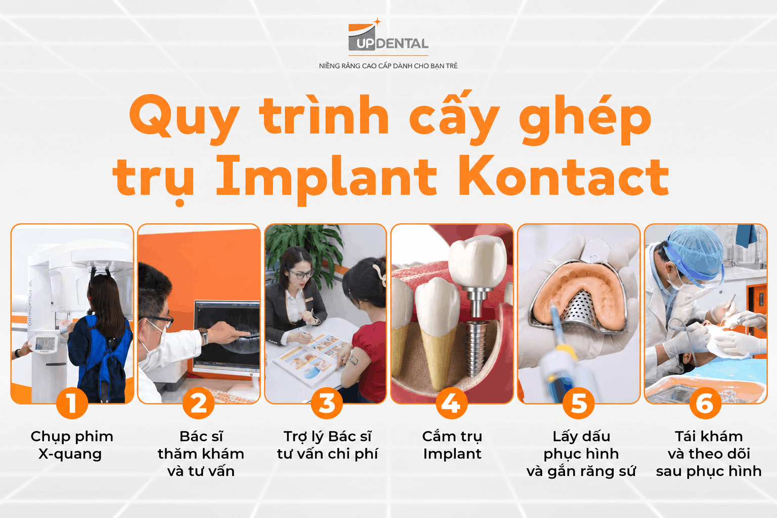 Quy trình cấy ghép trụ Implant Kontact