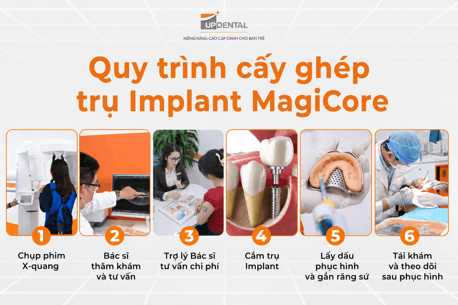 Quy trình cấy ghép trụ Implant MagiCore