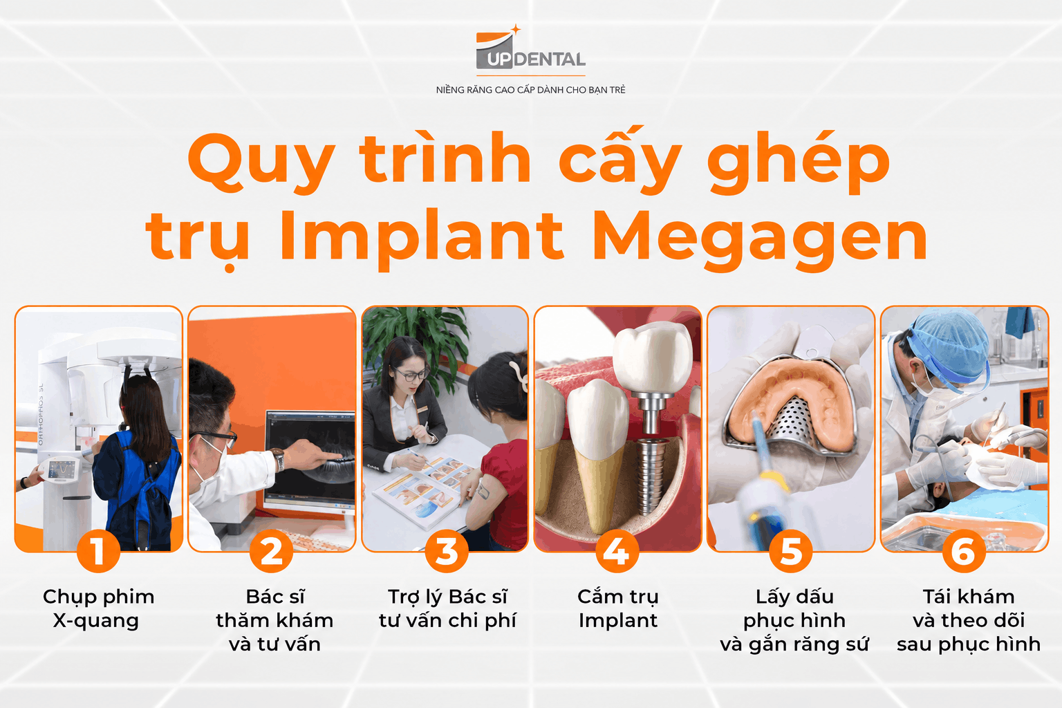 Quy trình cấy ghép trụ Implant Megagen