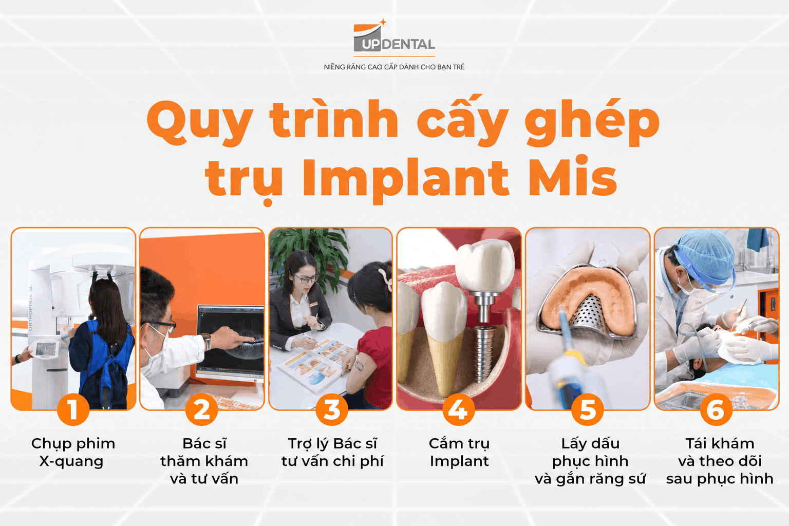 Quy trình cấy ghép trụ Implant MIS 