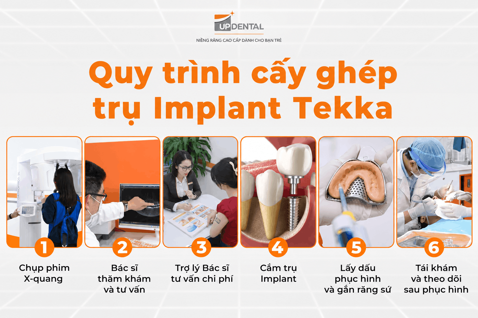 Quy trình cấy ghép Trụ Implant Tekka tại nha khoa