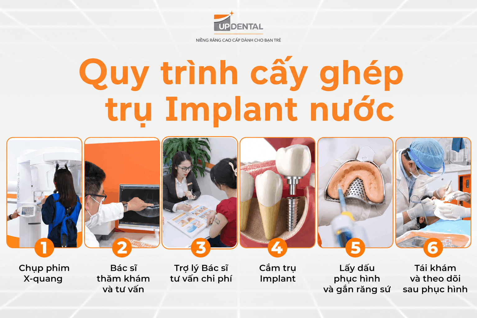 Quy trình cấy ghép trụ Implant nước (Ái sinh học)
