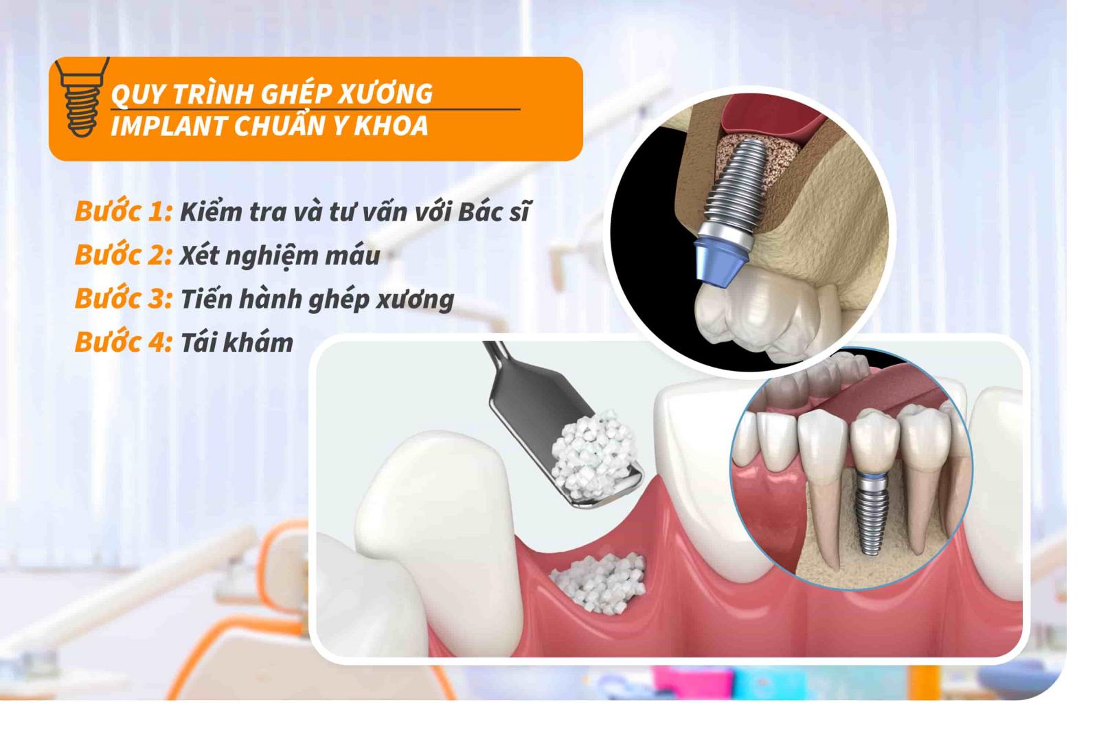 Quy trình ghép xương Implant chuẩn Y khoa