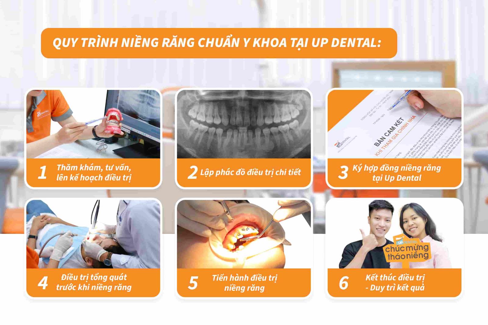 Quy trình niềng răng chuẩn y khoa tại Up Dental