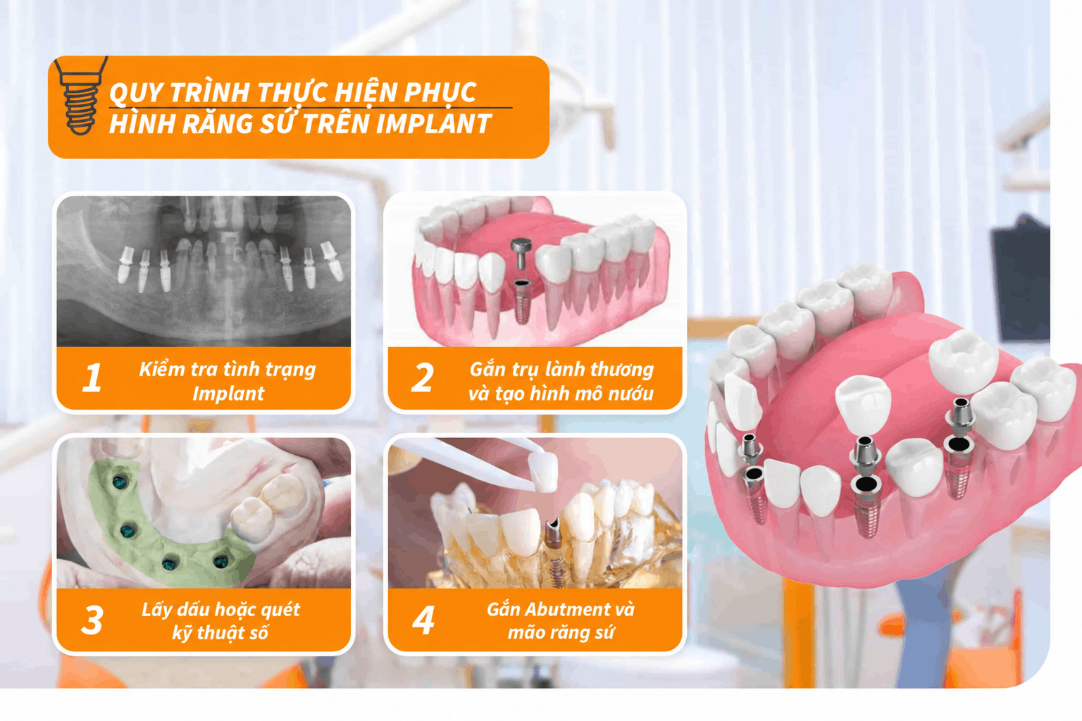Quy trình thực hiện phục hình răng sứ trên Implant