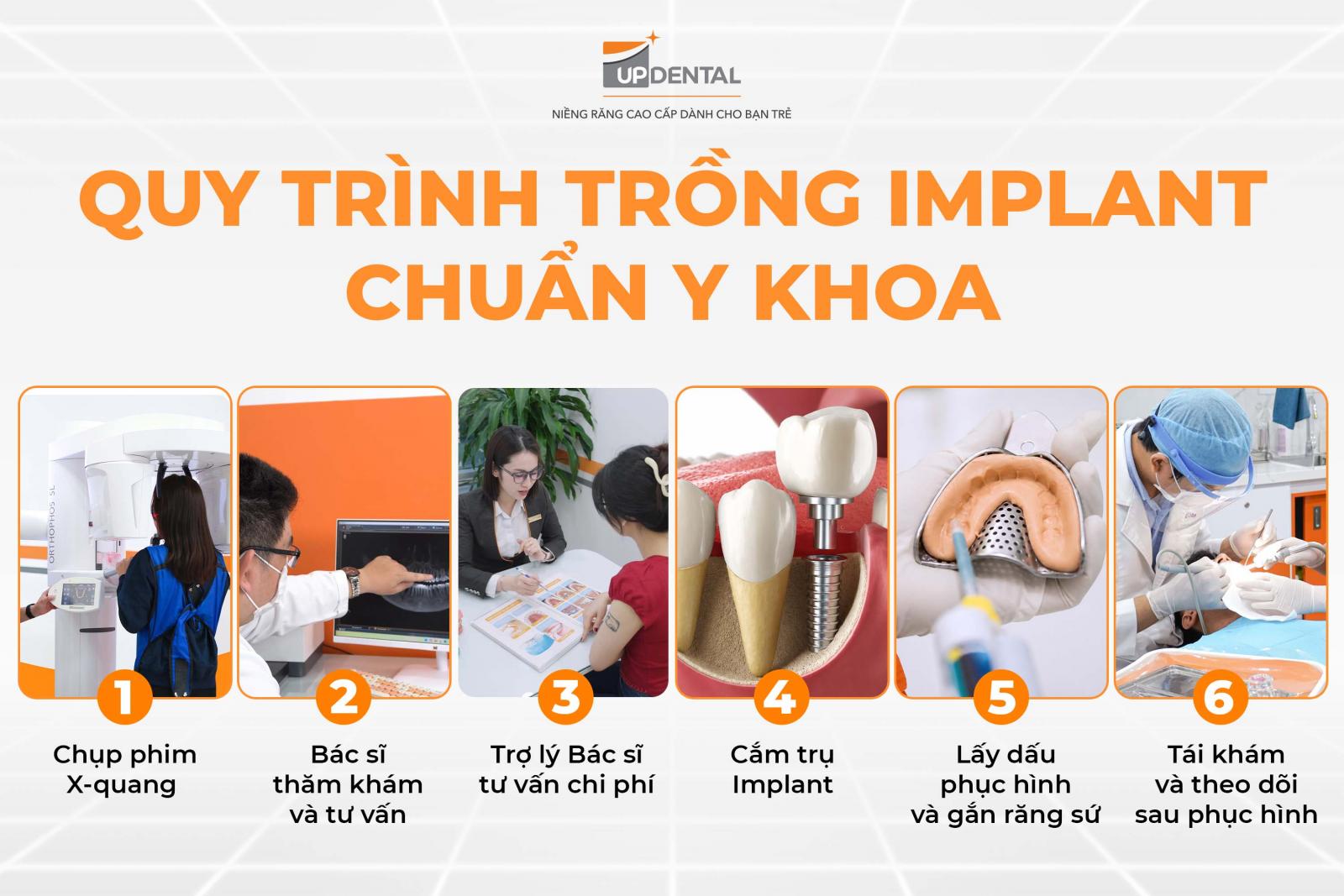 Quy trình cấy ghép Implant chuẩn Y khoa