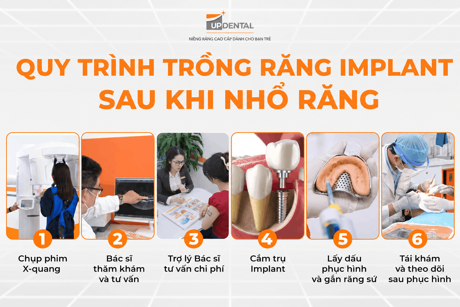 Quy trình trồng răng Implant sau khi nhổ răng