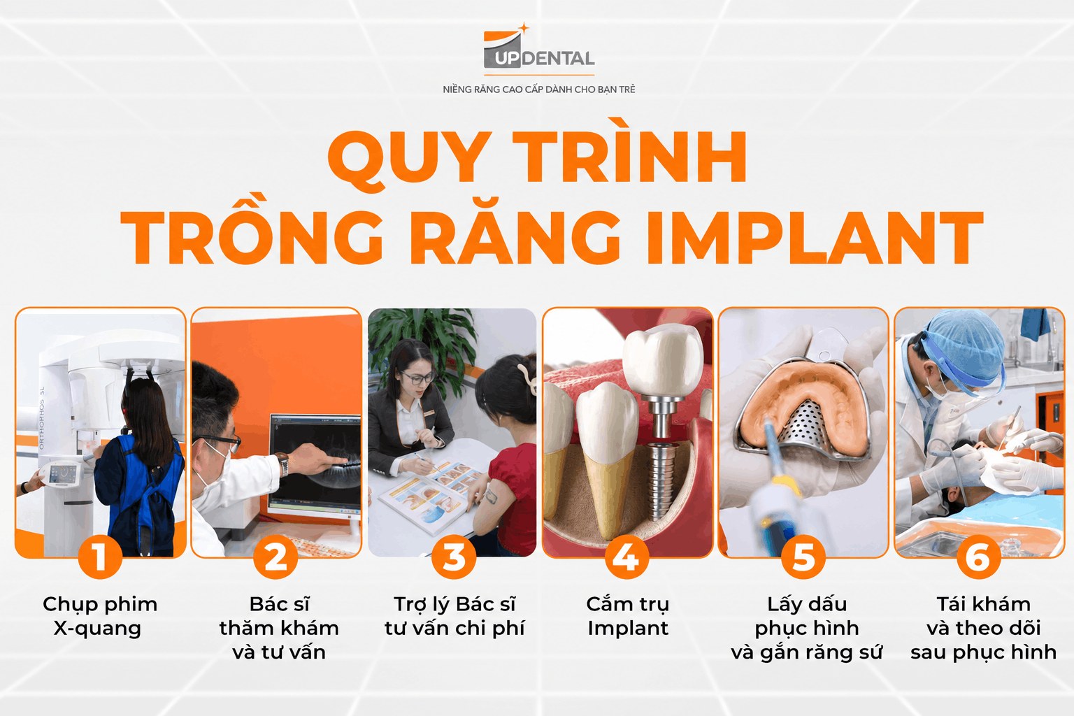 Quy trình trồng răng Implant