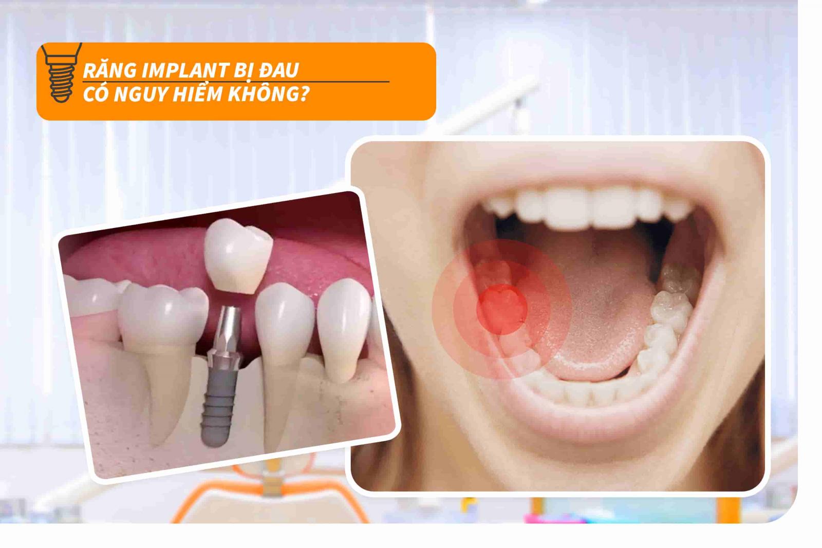 Răng Implant bị đau có nguy hiểm không?