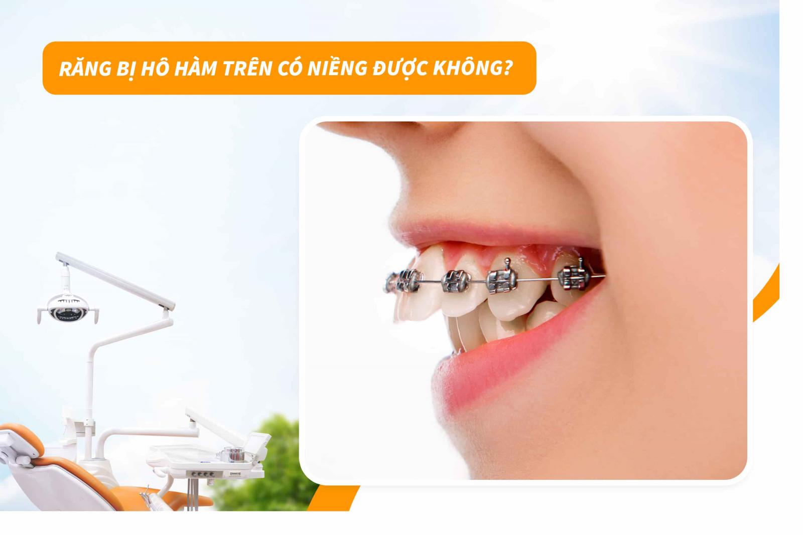 Răng bị hô hàm trên có niềng được không