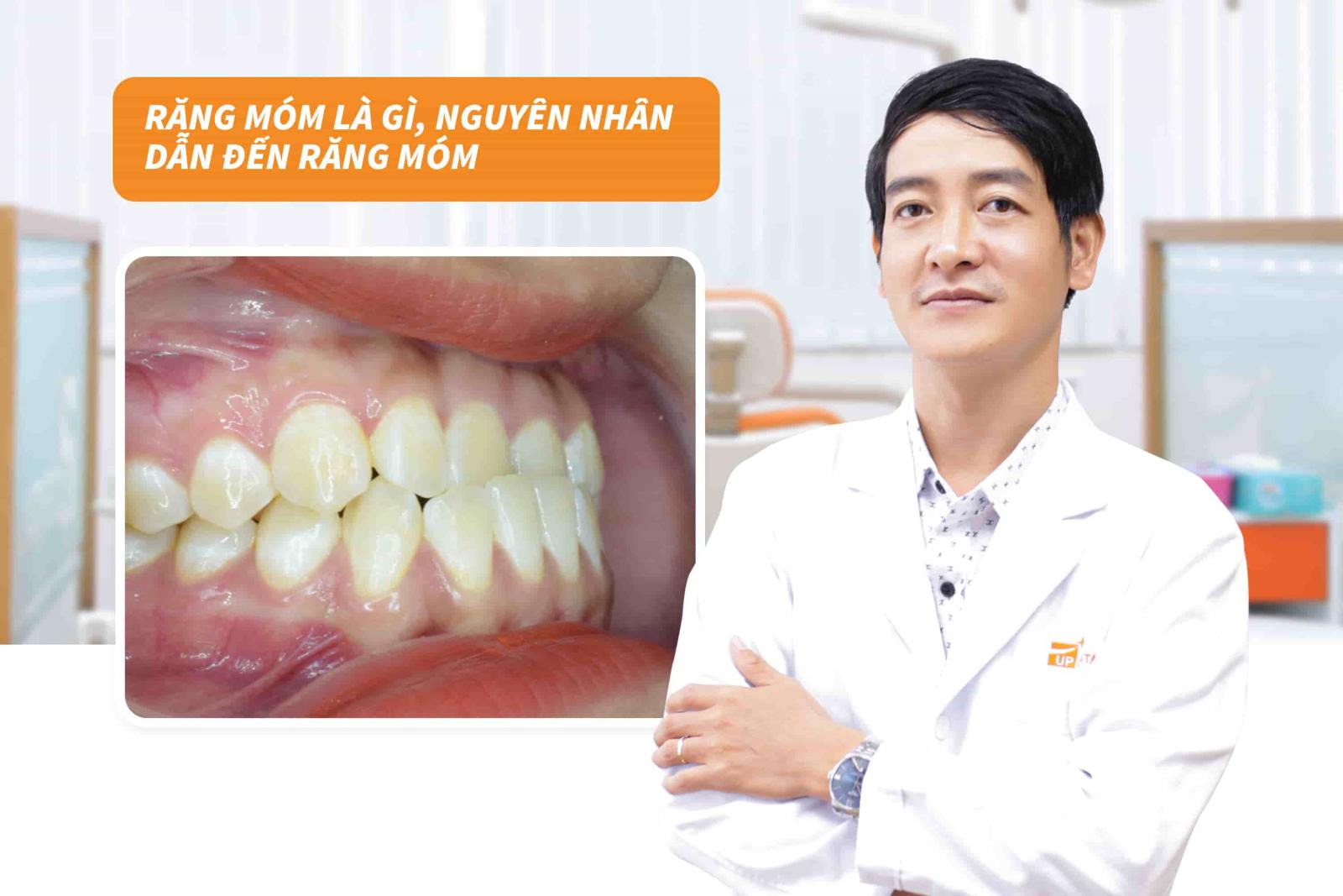 Nguyên nhân dẫn đến răng móm