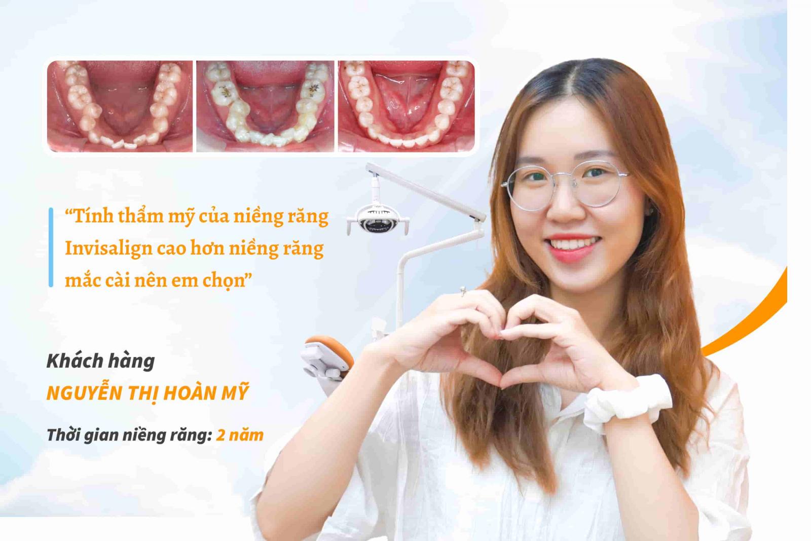 Review trải nghiệm niềng răng Invisalign