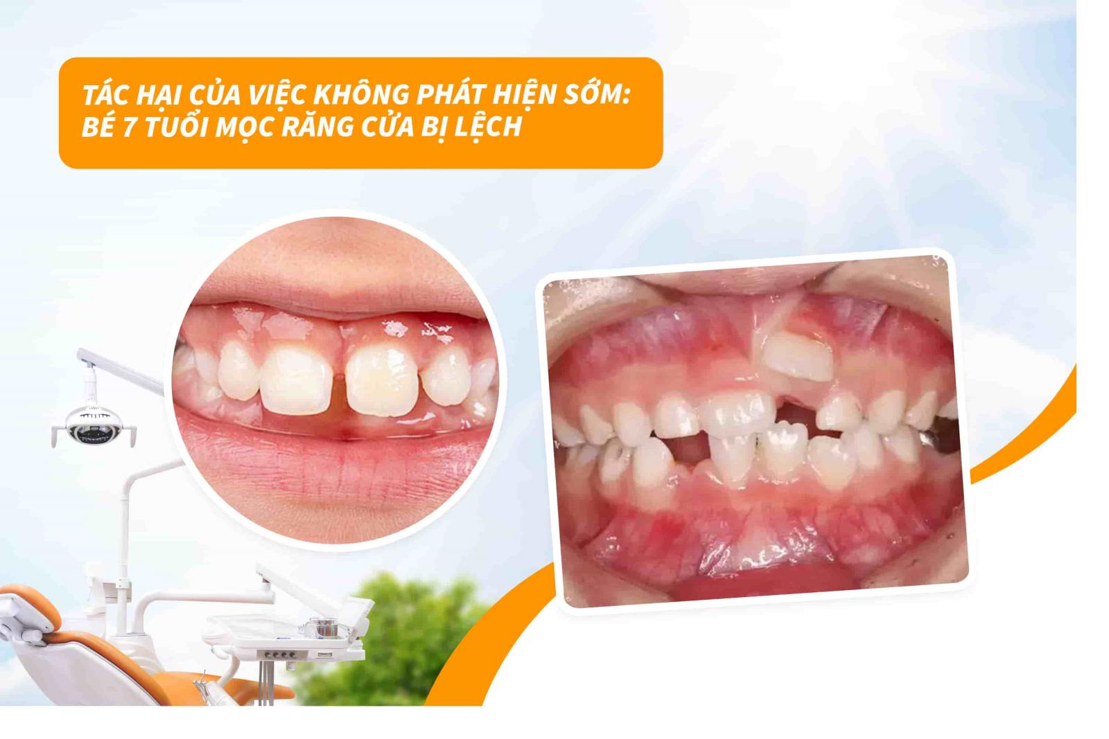 Tác hại của việc không phát hiện sớm: Bé 7 tuổi mọc răng cửa bị lệch