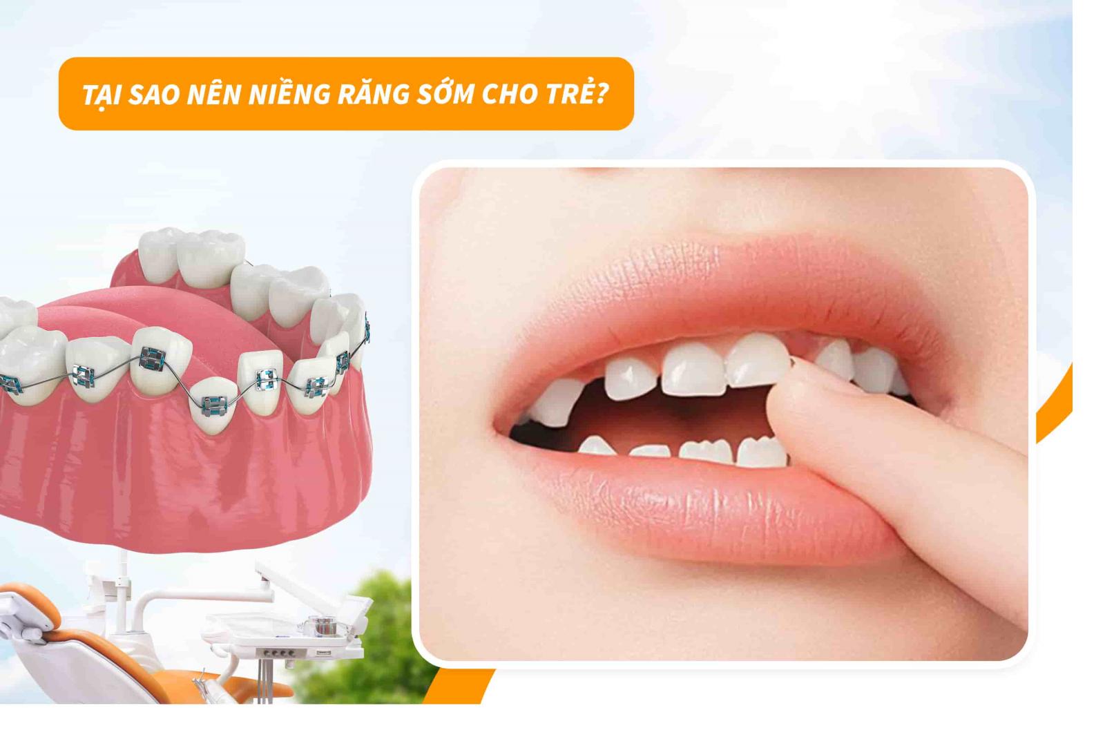 Tại sao nên niềng răng sớm cho trẻ 