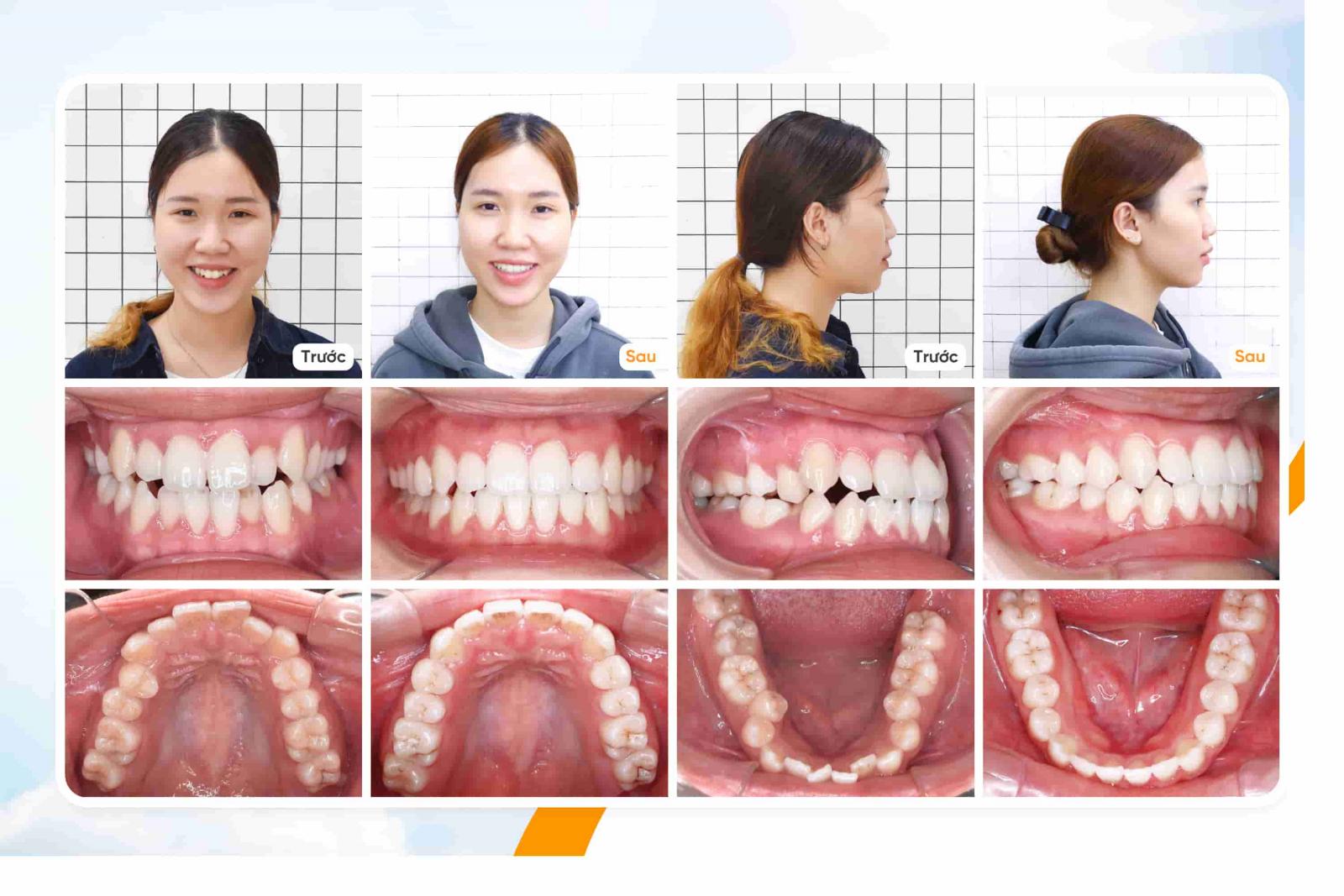 Thay đổi của Khách hàng Hoàn Mỹ sau khi niềng Invisalign tại Up Dental