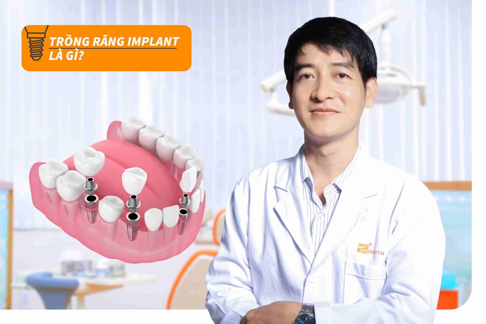 Trồng răng Implant là gì