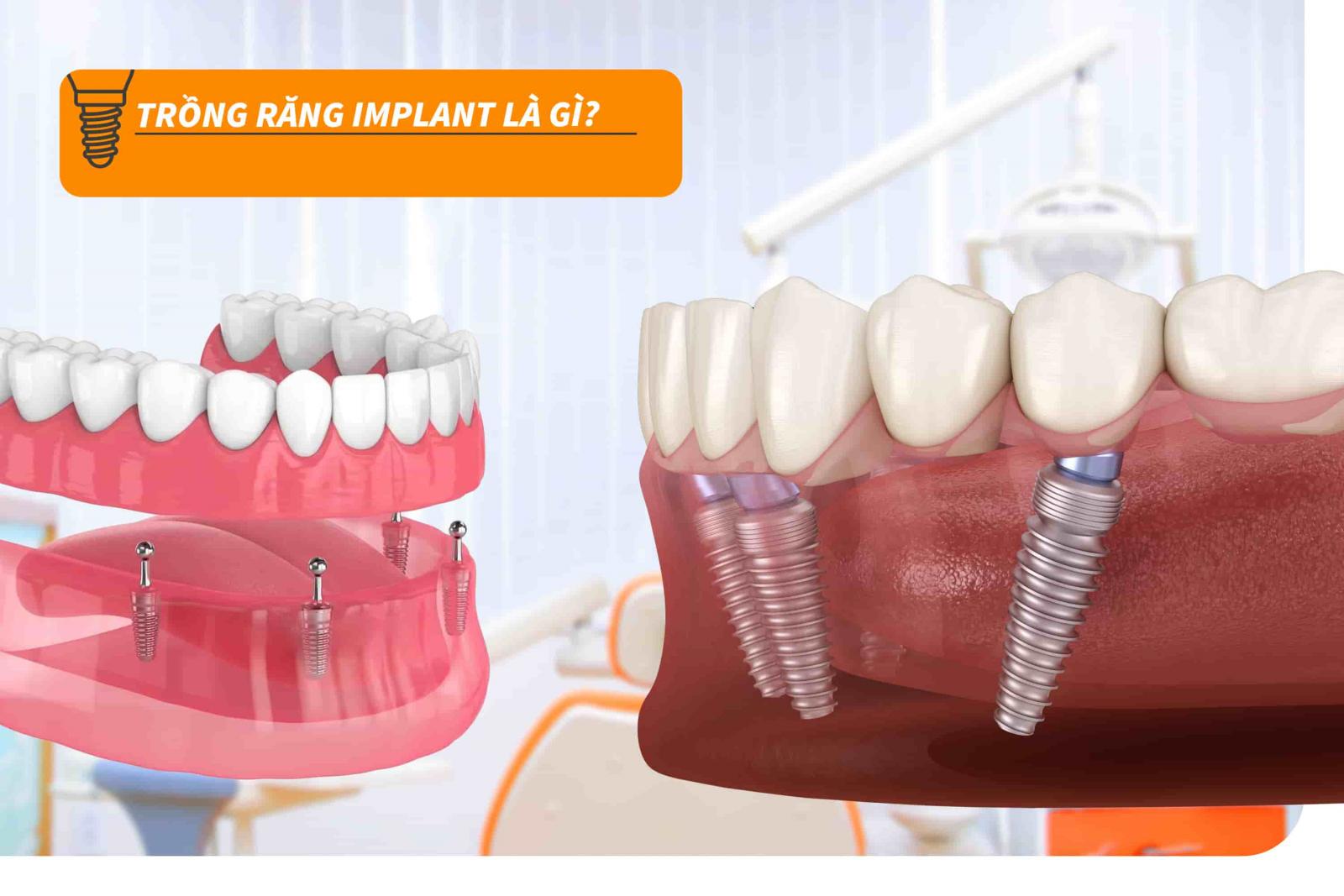 Trồng răng Implant là gì?