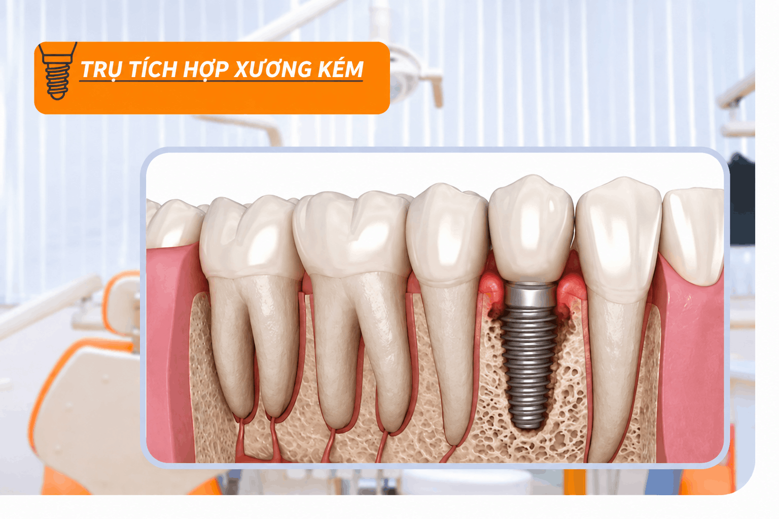 Trụ tích hợp xương kém