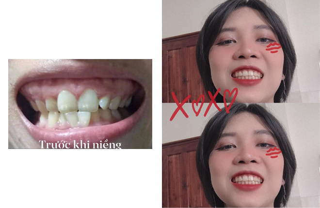 niềng răng up dental