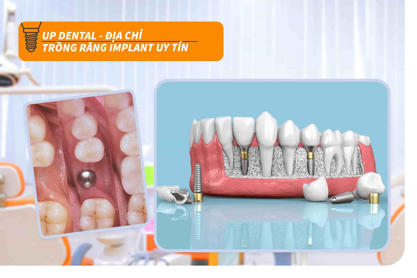 Up Dental - Địa chỉ trồng răng Implant uy tín 