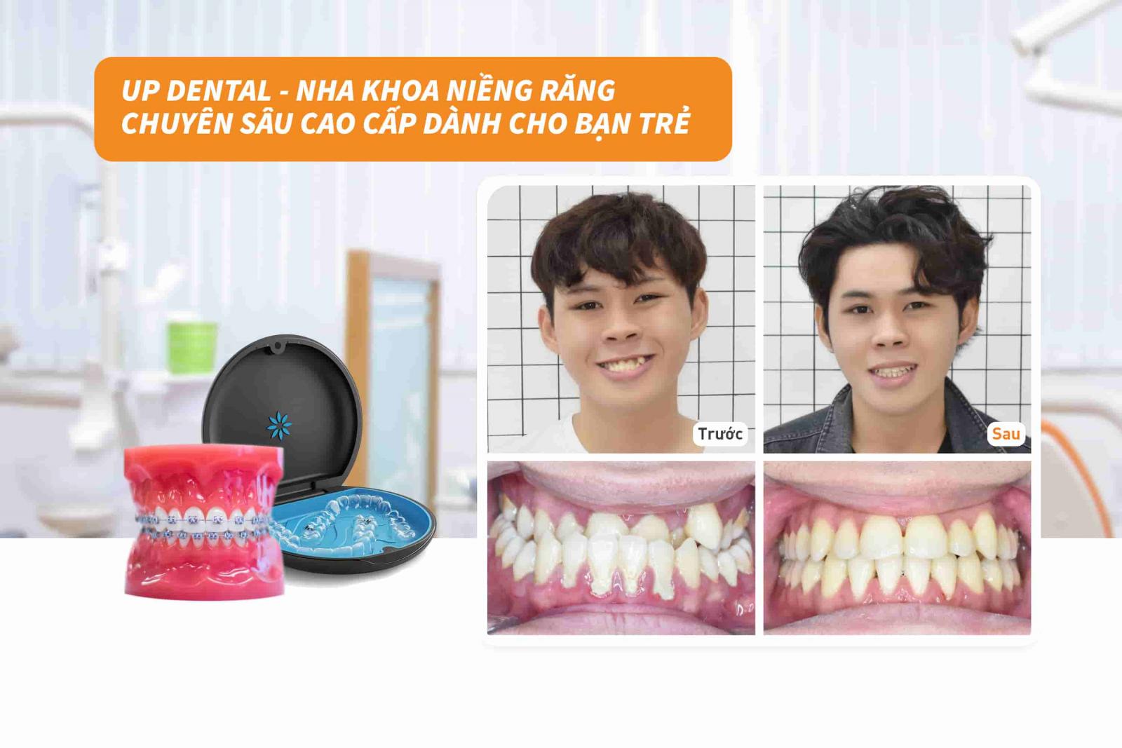 Up Dental nha khoa niềng răng chuyên sâu