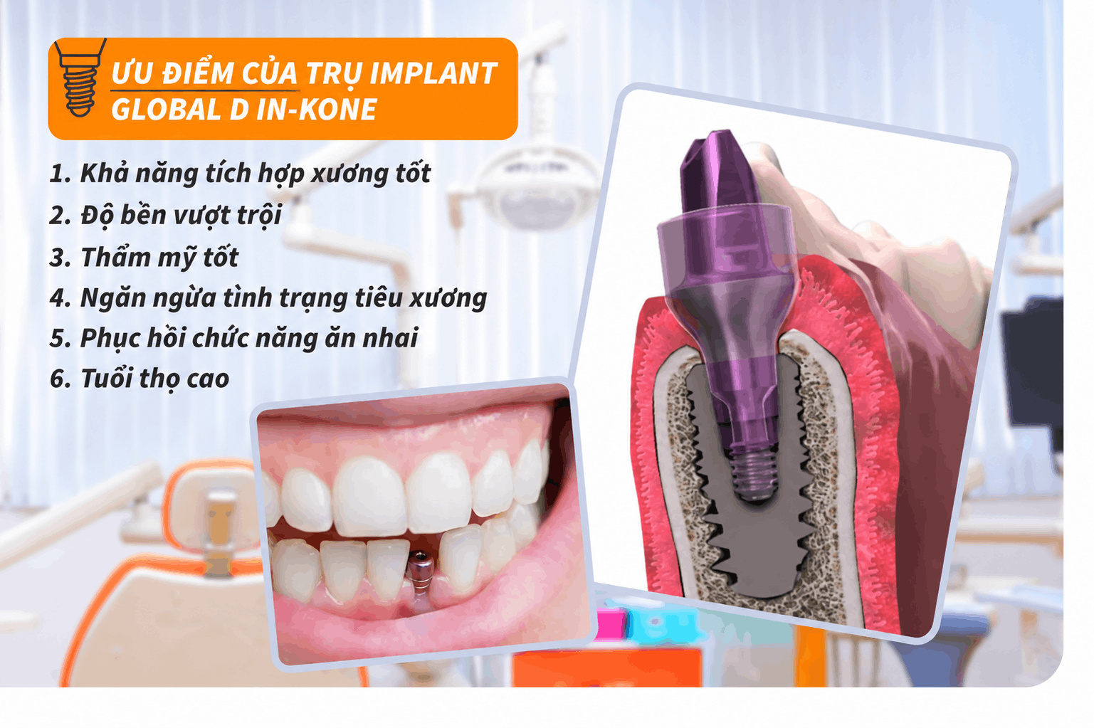 Ưu điểm của trụ Implant Global D In-Kone