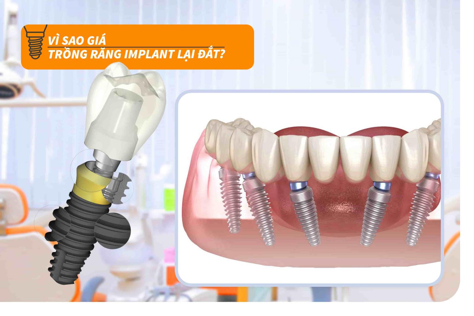 Vì sao giá trồng răng Implant lại đắt